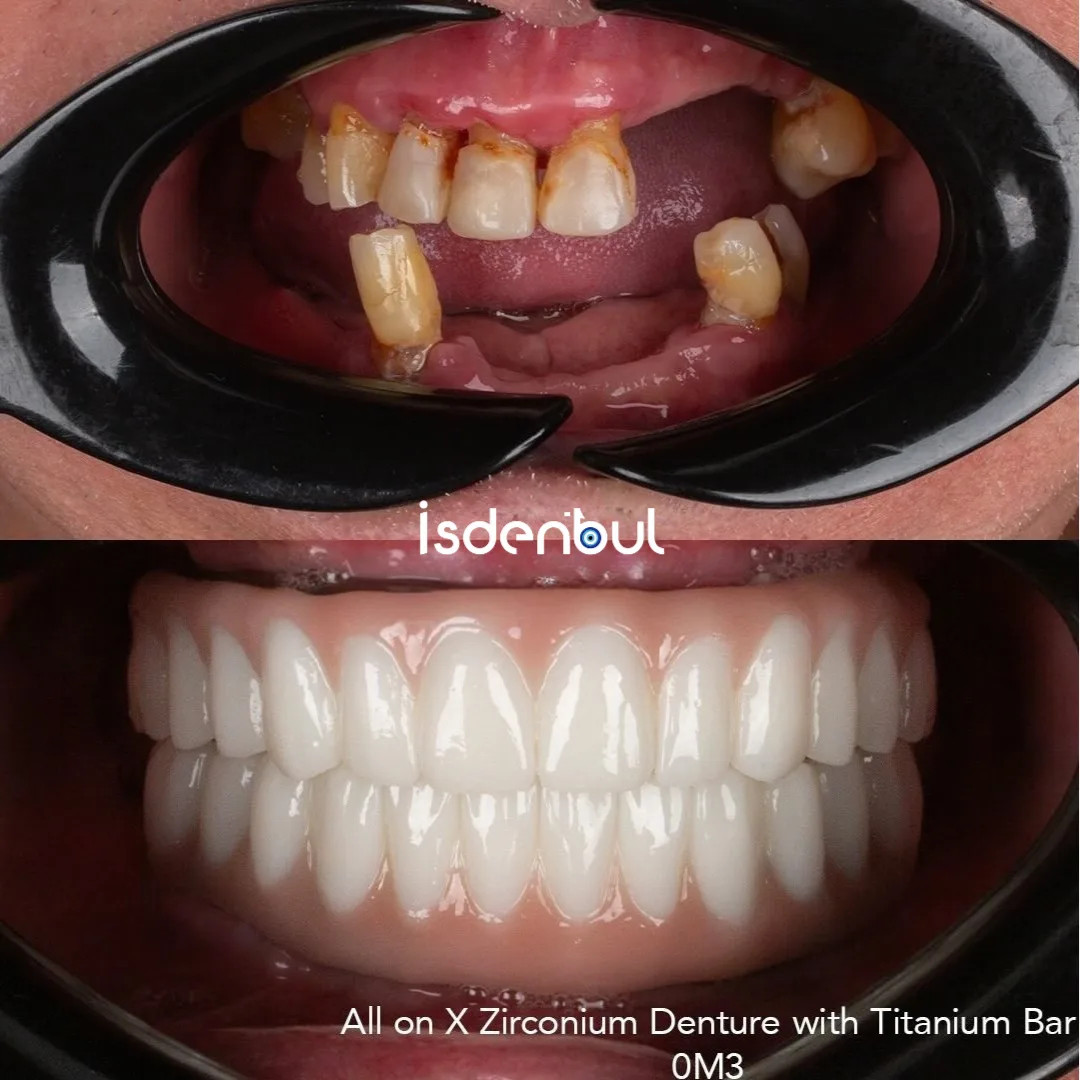 Dental X-Ray — Implant Planning