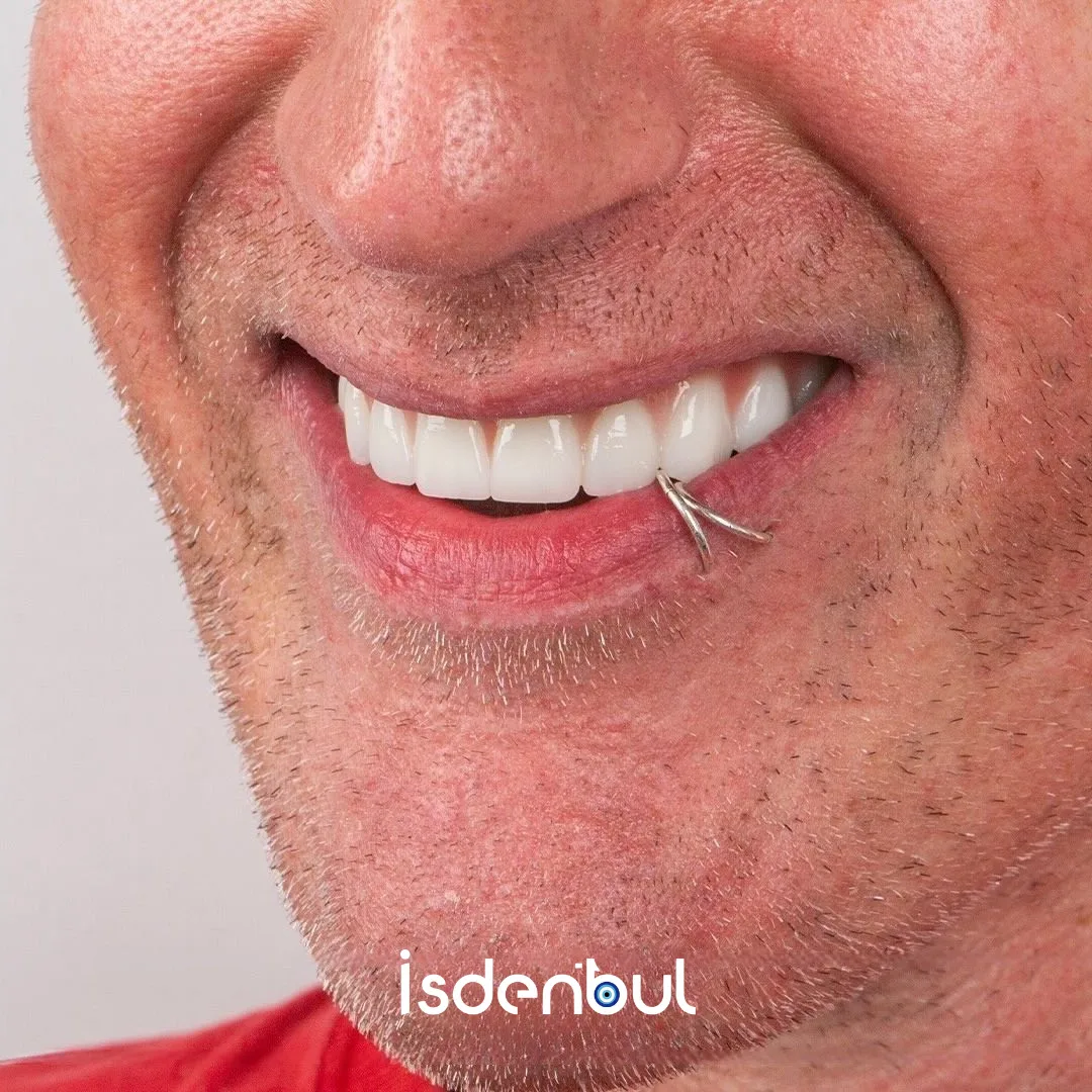Smile Result — Hollywood Smile