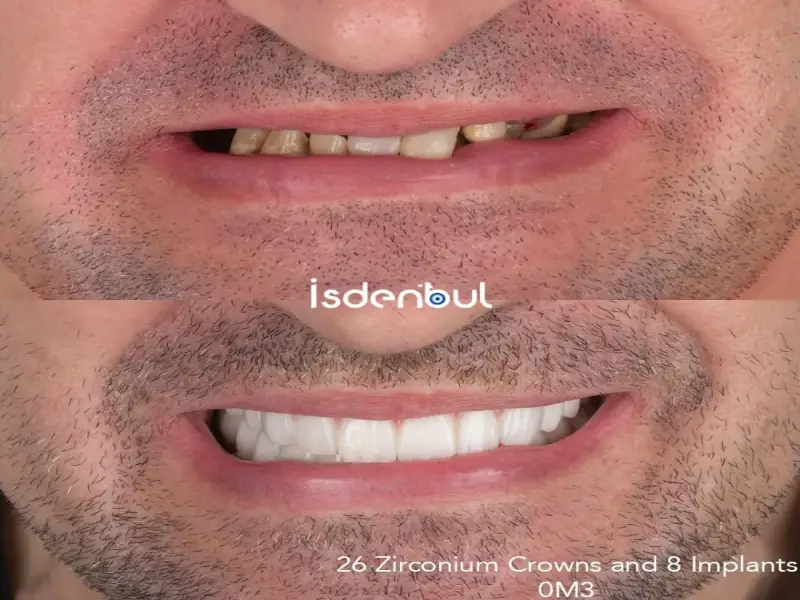 Dental Implants